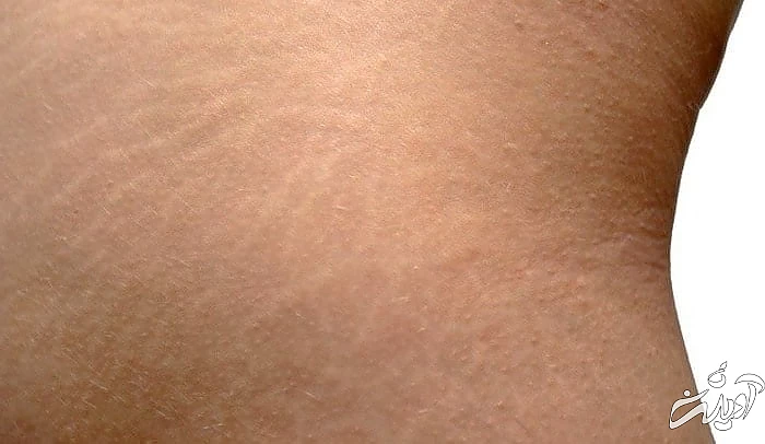 راه حل ترک پوستی